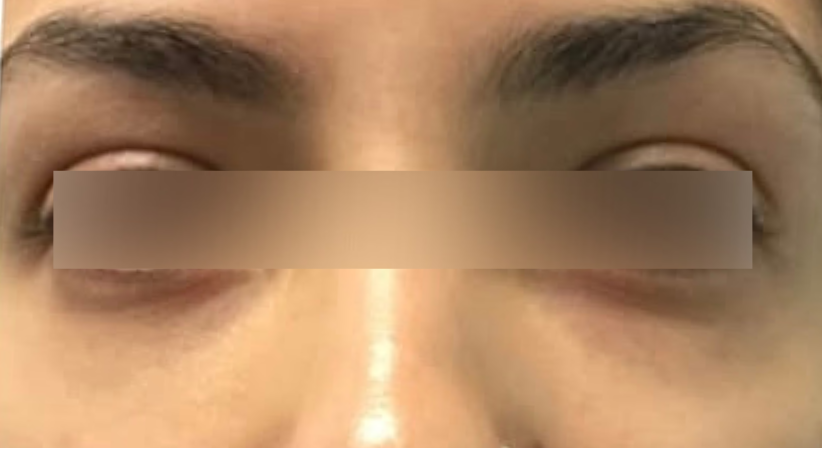 After image